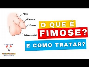 O QUE É FIMOSE E COMO TRATAR? (Dr Petrus Oliva)