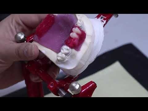 Lab # 5 : Part 2: Posterior Teeth Setting I Removable Partial Denture