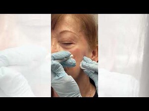 Hyfrecator for Skin Lesions | Simply Dermatology | Dr Kally Papantoniou