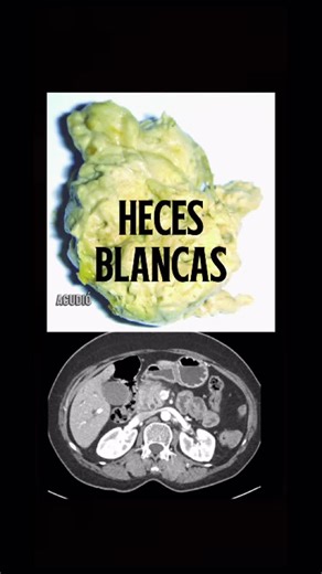 Dr. Jonah Serrano | Radiología on Instagram: "🔎 ¿Heces blancas? Podría ser más serio de lo que crees… La acolia (heces blancas o pálidas) ocurre cuando la bilis no llega al intestino. ¿Una causa alarmante? Un cáncer de páncreas que obstruye el colédoco. ⠀ 📸 En esta imagen te muestro un caso donde el tumor en la cabeza del páncreas bloquea el drenaje biliar, generando ictericia, coluria y acolia. ⠀ 🧠 Cuando veas heces blancas, piensa en una obstrucción biliar. No siempre será cáncer… pero a ve