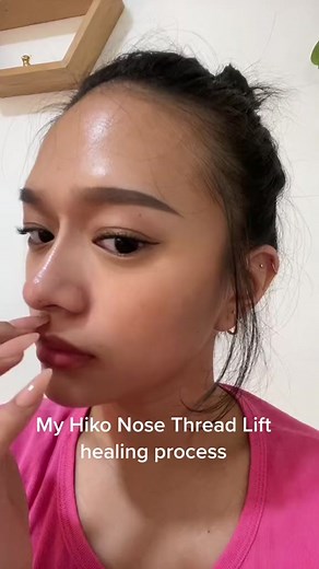 Hiko Nose Thread Lift Healing: Avatar Stage Process & Recovery