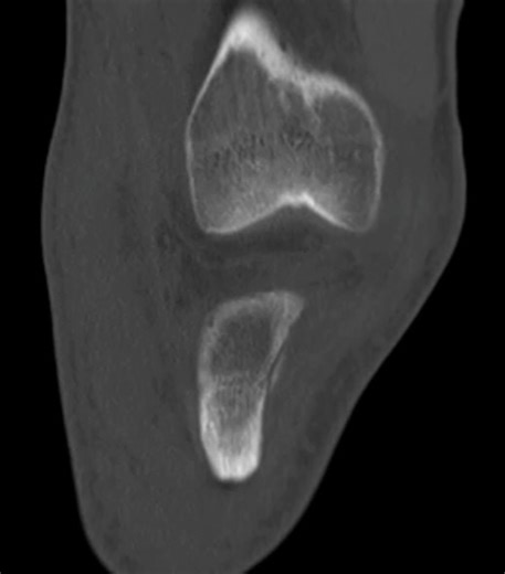 Orthopaedic Trauma on Instagram: "Schatzker II lateral tibial plateau fracture (with split and depression) in a 35 year old. Surgical steps are: ⭐️ Anterolateral approach ⭐️ Submeniscal arthrotomy, look for the meniscus and pull it out from the defect ⭐️ Open the lateral plateau wall ⭐️ Look inside at the depressed articular fragment ⭐️ Use an osteotome to mobilize the depressed fragment and elevate the fragment with bone punch under direct vision ⭐️ Use K-wires to secure the articular fragment 