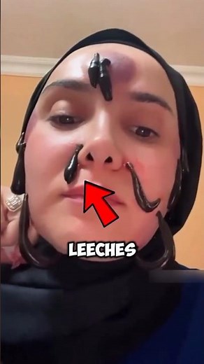 Leech Found Under the Microscope!😱