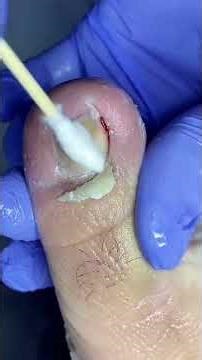 Long Toenails Finally Cut | Nail ASMR