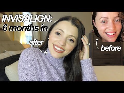 THE TRUTH ABOUT INVISALIGN / Before + After 6 months + FAQ Answered