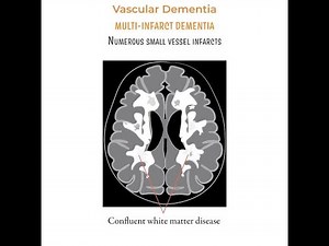 Multi Infarct Dementia MID ; Multiple Cerebral Infarcts, Large, Small Vessel Disease