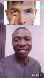 25K views · 679 reactions | What causes jaundice #fblifestyle | Nigeria Health Blog | Facebook