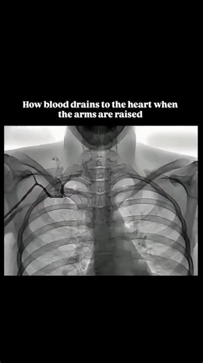 Health & Medicine with Harsha J on Instagram: "💓 How Blood Drains to the Heart When the Arms Are Raised When you raise your arms above your head, blood still has to flow back toward the heart — but now it’s working with gravity instead of against it! Here’s how it happens step by step 👇 🩸 1. Venous Return Pathway from the Arm Blood from the hand and arm drains through these main veins: 1. Superficial veins → Cephalic vein (along the lateral arm) Basilic vein (along the medial arm) 2. Deep vei