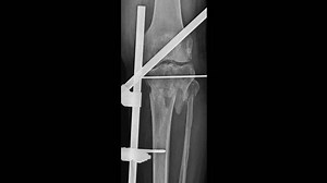 Lower Limb Fracture Fixation X-ray Analysis Stock Footage Video (100% Royalty-free) 3525509663 | Shutterstock