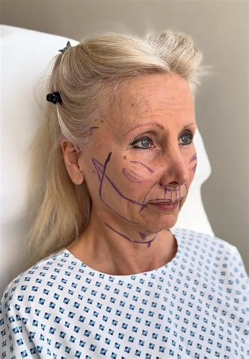 A 62-year-old American woman came to Shanghai alone for a facelift, claiming she regained her lost youth. The results were truly remarkable, making her look at least 15 years younger. Chinese-style facelifts are truly remarkable.#facelift #9dfacelift #整容 #拉皮手术 #面部提升