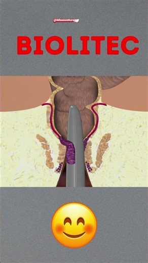 Painful Piles? See This Surgery Fix! 💉 #medical #procedure #treatment