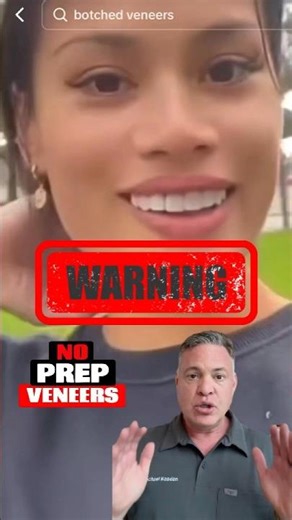 Why No Prep Veneers Are Risky