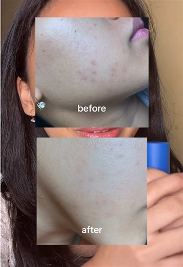 Effective Solutions for PIE and PIH Treatment