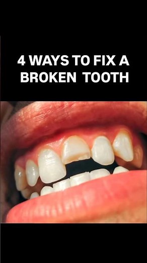 How To Fix A Chipped Tooth (Broken Tooth Repair Options)