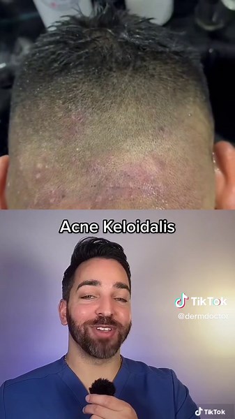 Understanding and Treating Acne Keloidalis Nuchae