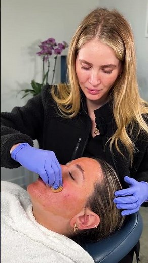VI Peel for Acne & Acne Scarring with Nurse Lauren