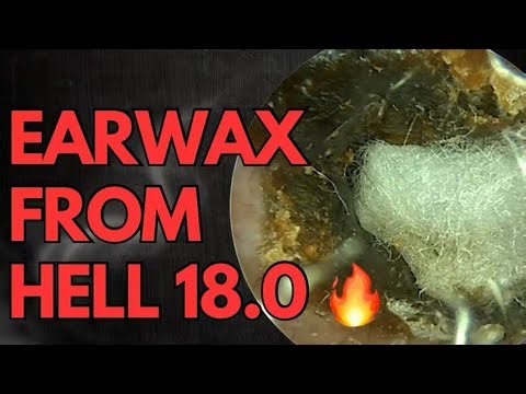 Extreme Ear Wax Removal - You Won't Believe What Came Out! (31)