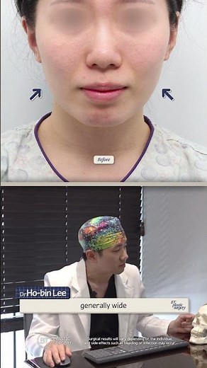 Facial Contouring Surgery Korea Before and After | Jawline & V-Line Transformation Results