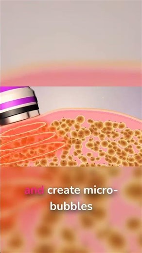 Ultrasound Bubbles Literally Explode Your Fat #science #bodytransformation