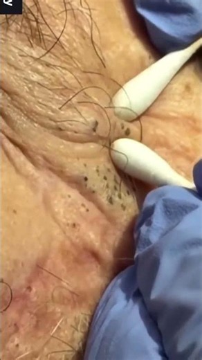 Pop Nuggets 👀#pimplepopping #satisfying #shortsfeed #blackheads #viralvideos