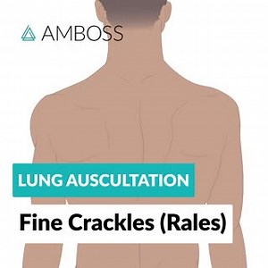 🎧 Headphones on! In addition to inspection, palpation, and percussion, examination of the lungs also involves stethoscope auscultation. In this video you will hear fine crackles (rales) in the basal portion of both lungs, especially during inspiration. Fine crackles are abnormal lung sounds that can be heard, for example, in patients with pneumonia. Listen to more lung auscultations via the AMBOSS Lung Auscultation Library Article (link in bio): https://go.amboss.com/FineRalesFB #ambossmed #med