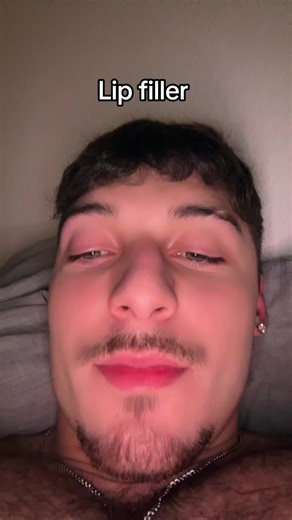 Understanding Lip Fillers: Everything You Need to Know