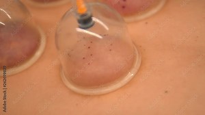 Wet cupping process - close-up view. Macro shot of traditional Chinese medical practice.