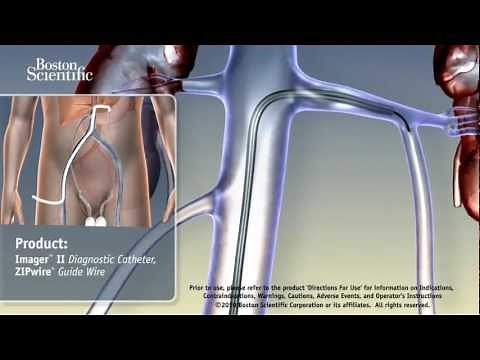 FIS - Varicocele Embolization