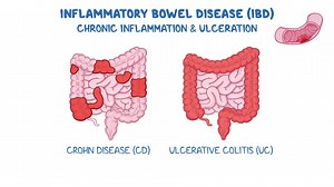 Video: Inflammatory Bowel Disease - Video Explanation! | Osmosis | Osmosis