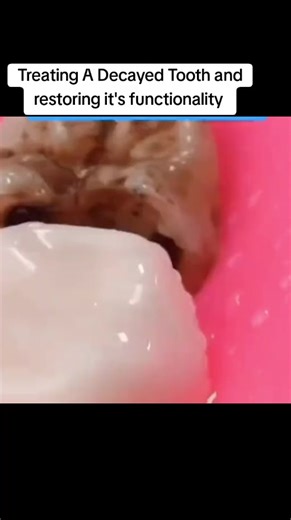 Save your tooth today from pain, Sensitivity, decay and infection. A root canal treatment at only Kes 8000 for one tooth. Book a session with us now 🙂........#nairobidentalalpha #toothdecay😢 #Root Canal Treatment #toothcavity #toothrestoration
