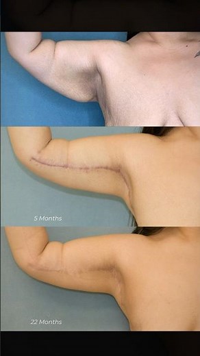 Brachioplasty (Arm Lift) before and after ✨