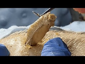 [ASMR] Huge Armpit Blackhead Extraction – Dr. Pimple Popper’s Most Satisfying Removal Ever! 0754