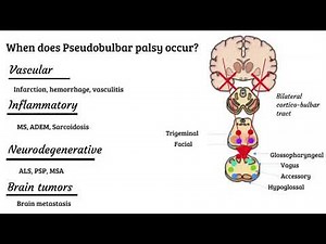 Bulbar vs pseudobulbar palsy