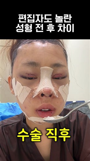 쀼쀼 on Instagram: "편집자도 놀란 성형 전 후 차이 유튜브 ’쀼tv루니‘ 검색👆 전후 차이&비하인드 스토리 확인하세요! - 성형 정보 알려드려요👍 쀼앱 다운로드 후 [ 루니2 ] 검색"
