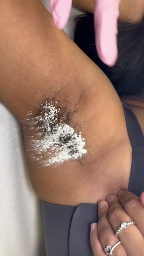 Waxing hair removal: tips for excessive hairs