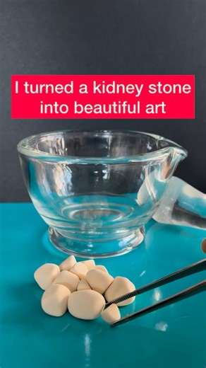 Adolfo Sánchez-Blanco, PhD🇪🇸🇺🇸 on Instagram: "This particular stone is a struvite stone. Struvite is a crystalline mineral made of magnesium ammonium phosphate, and it commonly forms in alkaline urine (often associated with urinary tract infections). . When struvite is exposed to a strong acid like hydrochloric acid (HCl), the low pH disrupts the crystal structure. The acid protonates the phosphate component, disrupting the crystal structure. As the structure brea