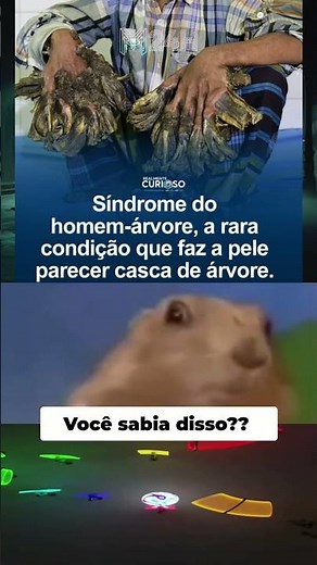A Síndrome do Homem-Árvore: Entenda essa condição rara que faz a pele parecer casca de árvore 🌳