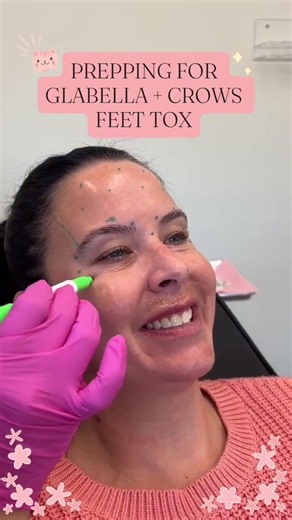 Prepping for Glabella + Crows Feet Tox