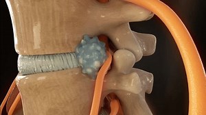 Sciatic nerve pain due to herniated disc,3d animation.