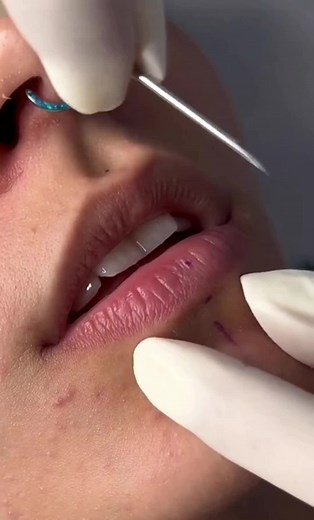 Skin Procedure Demonstration in Clinical Setting
