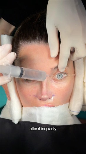 Thick skin rhinoplasty requires strategy—not just surgery. #barbienose