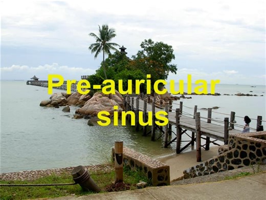 Preauricular Sinus Infection and Surgery to Resolve the problem