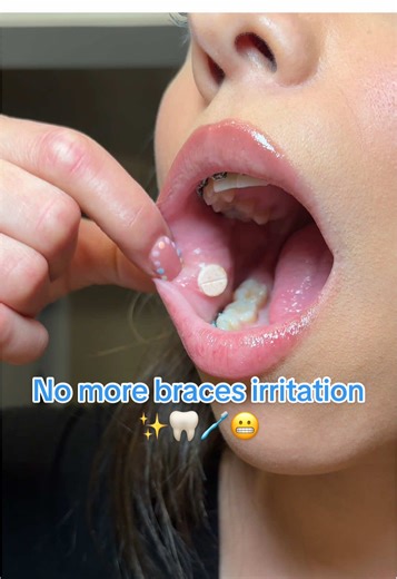When braces irritation tries to ruin your day @Dentemp saves it! You can find these canker covers on Amazon! #dentemppartner #braces #bracestip #adultbraces #bracesjourney