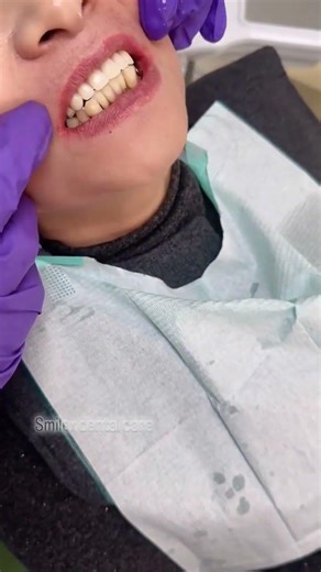 upper complete denture #dentist