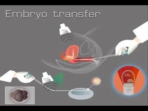 Typical IVF ET Cycle -In Vitro Fertilization–Embryo Transfer Cycle