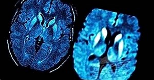 Maladie de Creutzfeldt-Jakob (MCJ): causes, symptômes, diagnostic et traitement