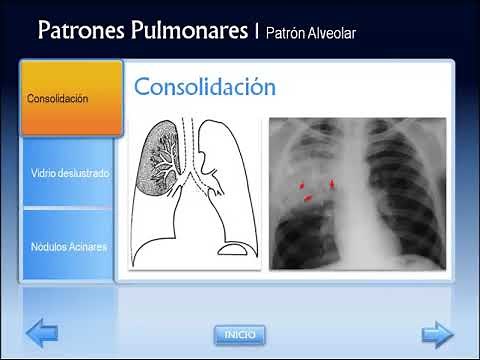 Patrones Pulmonares en Radiología y TC