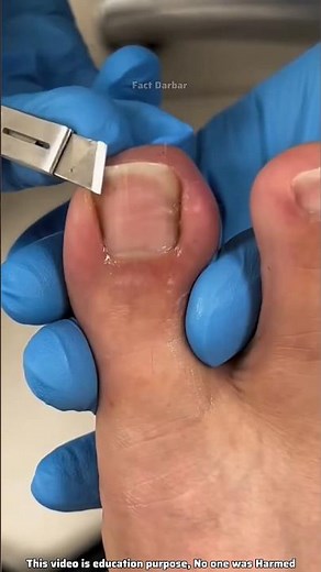 How To Cut Toenails Correctly 💅😨!!!