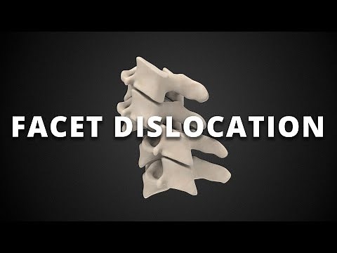 Facet dislocation: unilateral, subluxation, perched, and locked facets