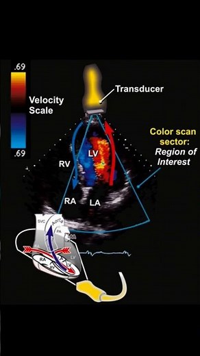 Color flow Doppler in ECHOCARDIOGRAPHY 🫀